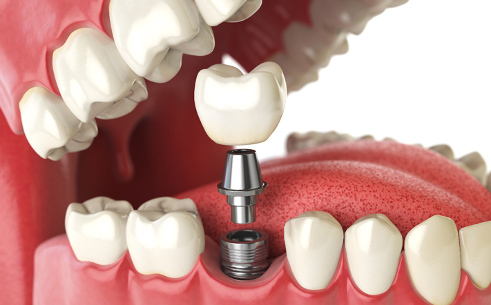 Single Tooth Implant